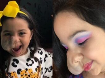 «Μαμά, Είμαι Άσχημη»: Μητέpα πείθει την 6χpονη κόρη της με όγκο στο πρόσωπο πως είναι πανέμορφη