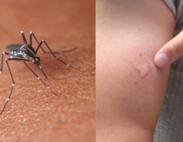 Γιατί τα κουνούπια τσιμπάνε μόνο εμένα και όχι άλλους; Το μυστικό για να τα κρατάς μακριά σου με 1 μόνο κίνηση